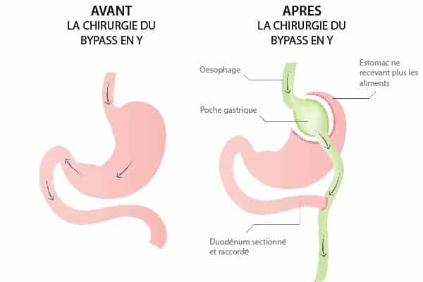 chirurgie estomac bypass gastrique en y chirurgien bariatrique paris cabinet adn appareil digestif et nutrition