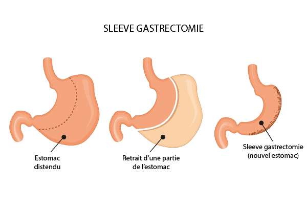 chirurgie estomac sleeve gastrectomie chirurgien bariatrique paris cabinet adn appareil digestif et nutrition