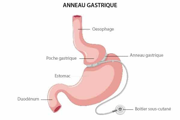 gastroplastie pose resultat anneau gastrique paris chirurgien bariatrique paris cabinet adn appareil digestif et nutrition