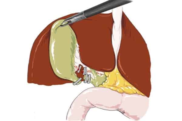 cholecystectomie chirurgie enlever vesicule billiaire chirurgien visceral et digestif cabinet adn paris