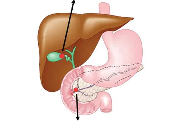 cholecystite aigue lithiase cholesterolique vesicule biliaire symptome operation chirurgien visceral et digestif cabinet adn paris