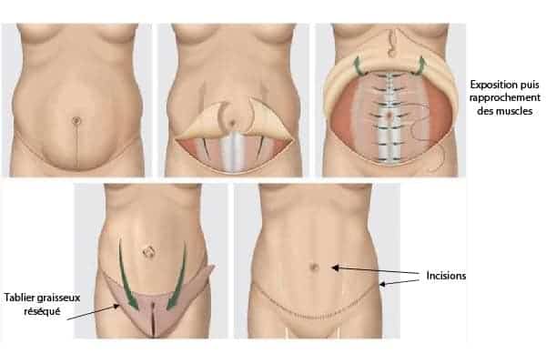 cure de diastasis avec abdominoplastie chirurgien parietale cabinet adn paris