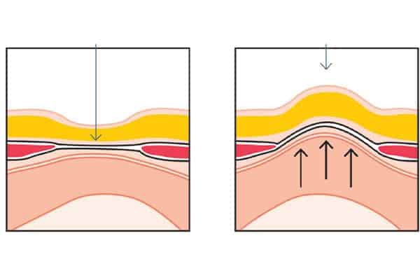 diastasis elargissement de la ligne blanche et diastasis contraction chirurgien parietale cabinet adn paris