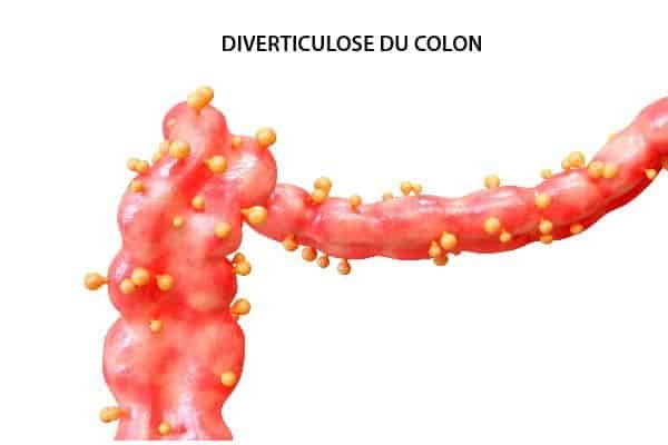 diverticules colon traitement medical diverticulose chirurgie viscerale et digestive chirurgie proctologique paris cabinet adn proctologue paris