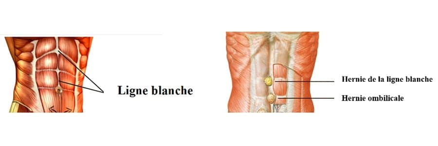 hernie ligne blanche hernie ombilicale schema chirurgie parietale paris chirurgie digestive viscerale paris cabinet adn