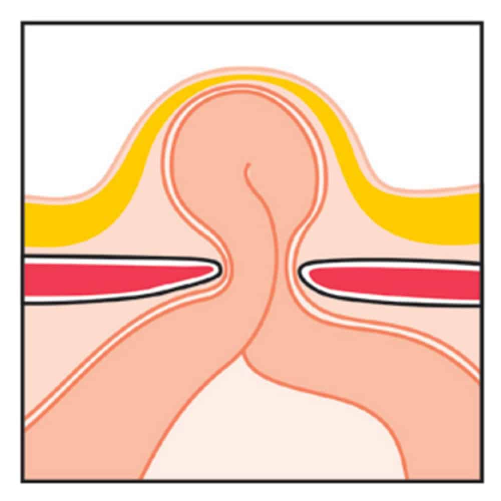 hernie ombilicale ligne blanche chirurgie parietale paris chirurgie digestive viscerale paris cabinet adn