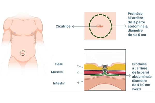 intervention voie ouverte prothese chirurgie parietale paris chirurgie digestive viscerale paris cabinet adn