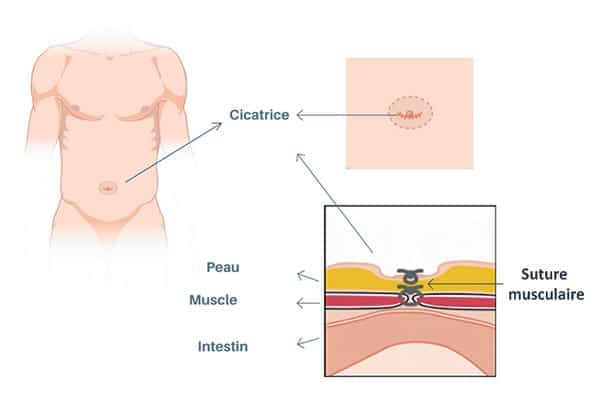 intervention voie ouverte raphie chirurgie parietale paris chirurgie digestive viscerale paris cabinet adn