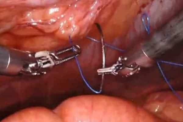 operation diastasis technique tarup chirurgien parietale cabinet adn paris