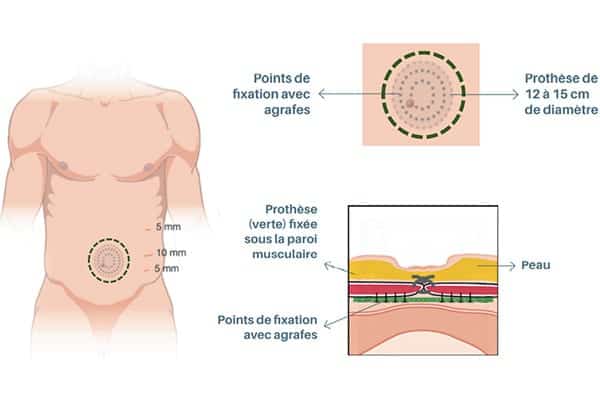 operation laparoscopie coelioscopie chirurgie parietale paris chirurgie digestive viscerale paris cabinet adn