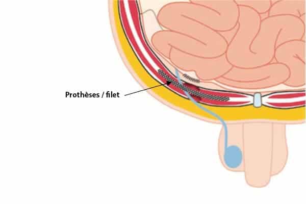 prothese hernie inguinale chirurgien parietale cabinet adn paris