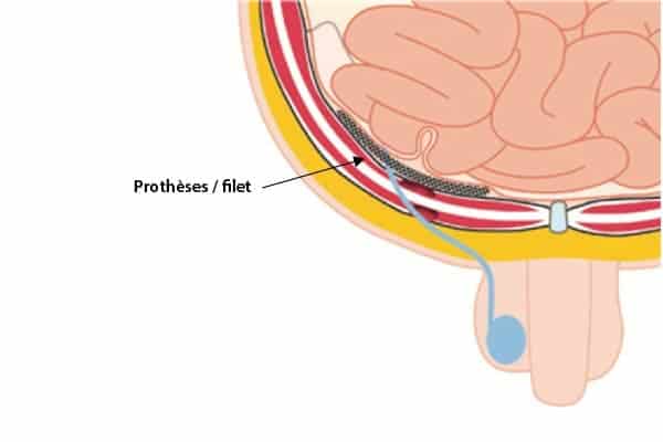 prothese hernie inguinale homme operation chirurgien parietale cabinet adn paris