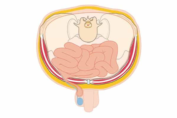 symptomes hernies inguinales testicule photo chirurgien parietale cabinet adn paris