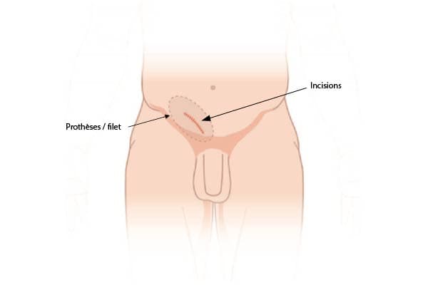 technique incision cutanee classique lichtenstein operation hernie inguinale chirurgien parietale cabinet adn paris