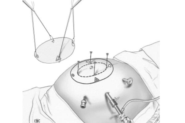 technique ipom cure de diastasis traitement chirurgical chirurgien parietale cabinet adn paris
