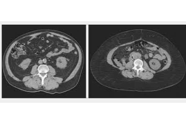 traitement diastasis echographie chirurgien parietale cabinet adn paris