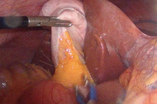vue operatoire vesicule sous le foie vesicule biliaire symptome operation chirurgien visceral et digestif cabinet adn paris