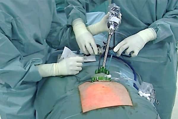 operation diastasis abdominal chirurgien parietale paris cabinet adn paris