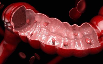 Polypes du côlon : dangereux ou pas ?