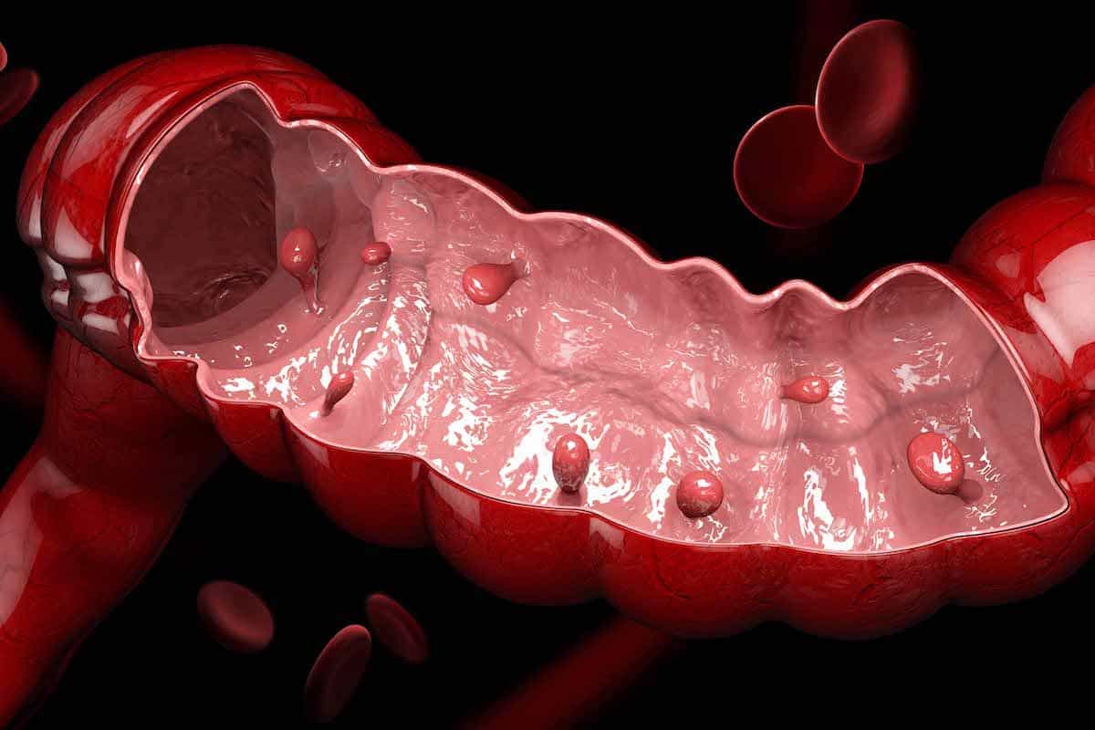 polypes-colon