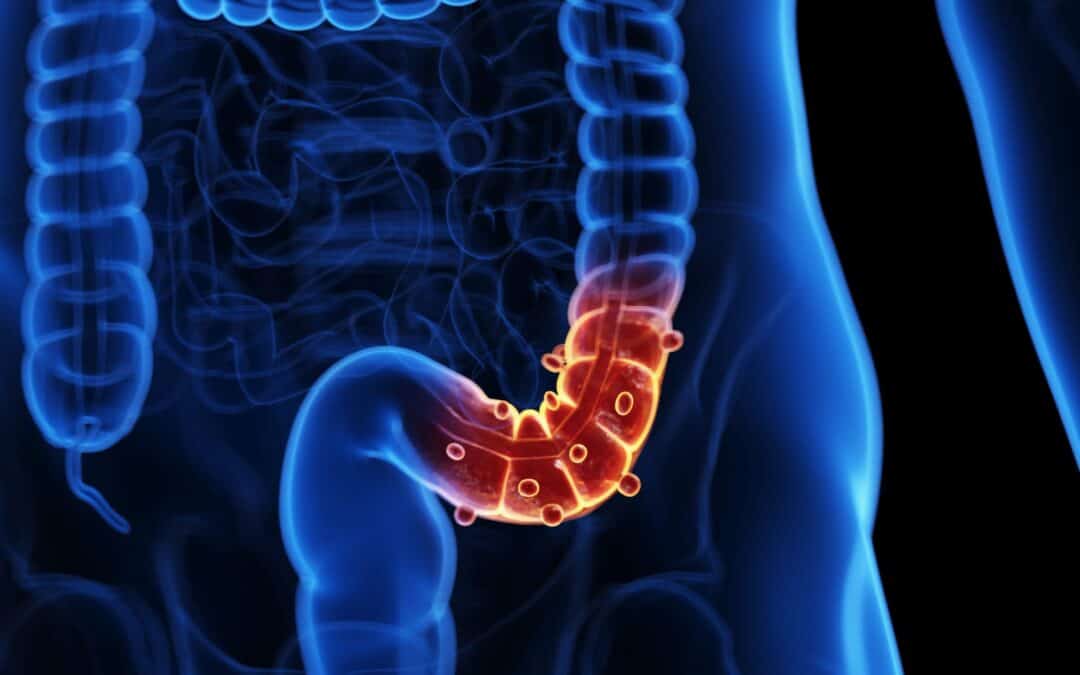 Diverticulite : quand les diverticules du côlon s&rsquo;infectent
