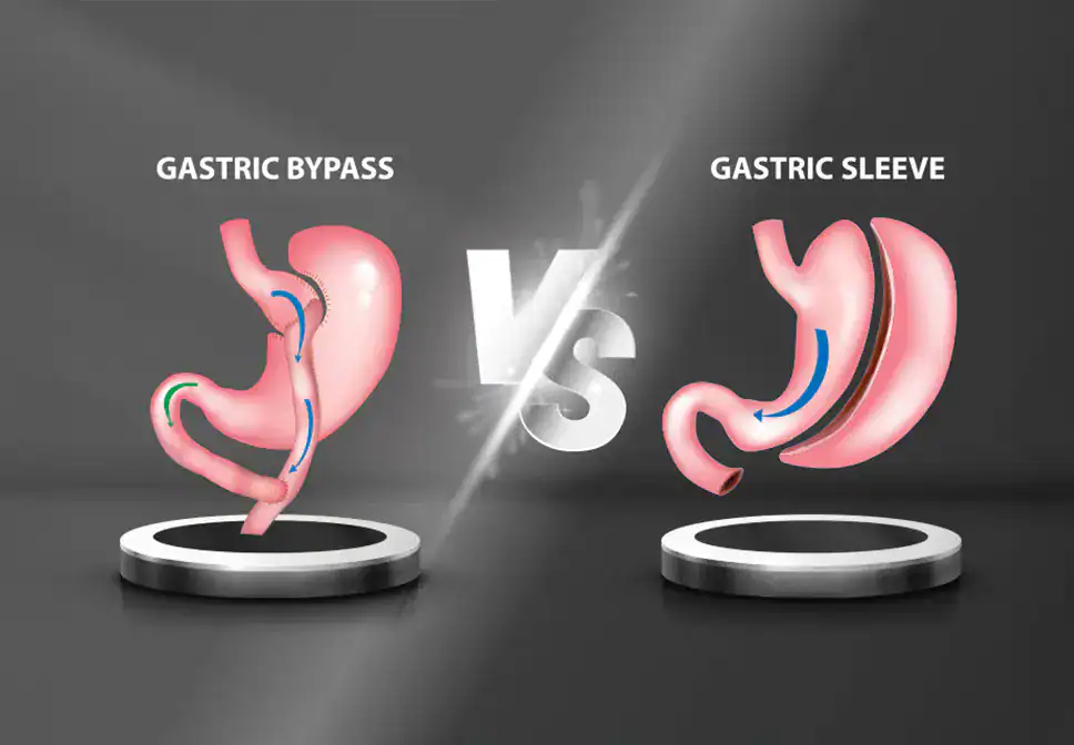 gastric-bypass-vs-gastric-sleeve