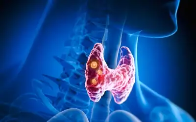 Nodule thyroïdien : faut-il vraiment s&rsquo;inquiéter ?