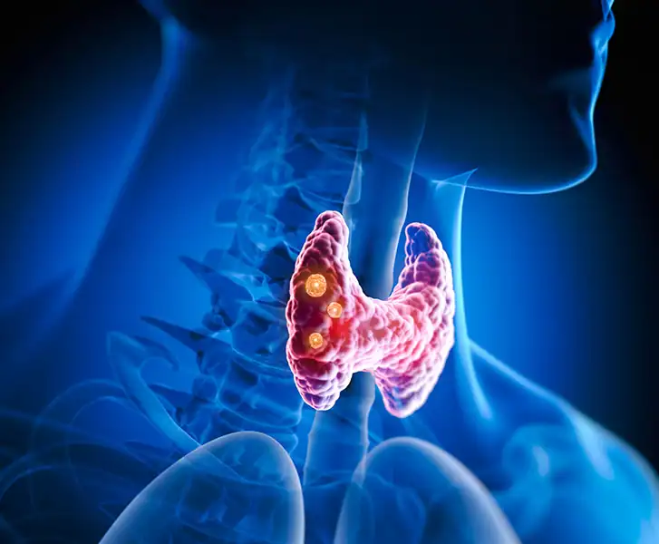 nodules-thyroide