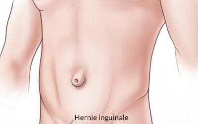 Hernie inguinale : faut-il opérer les deux côtés ?