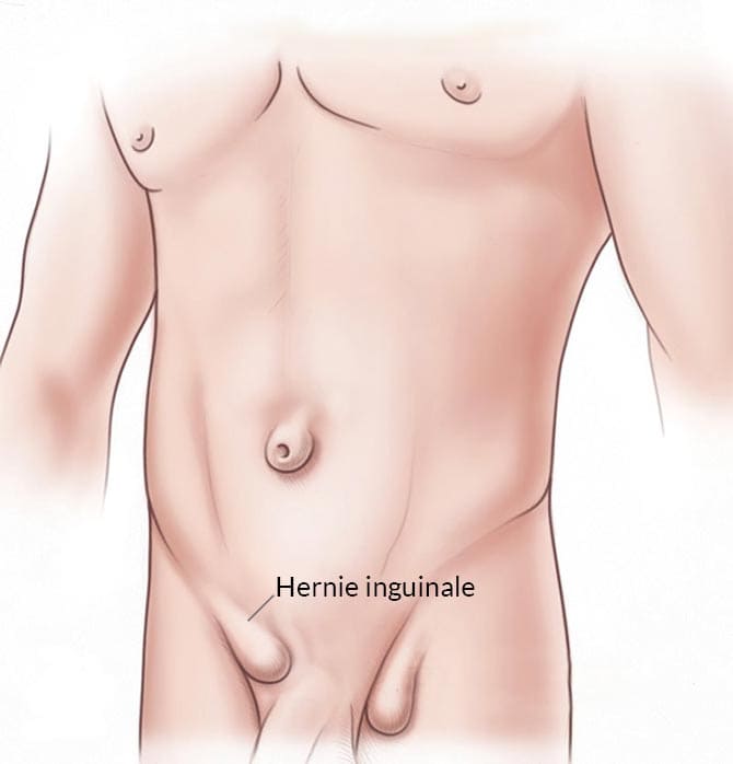 hernie-inguinale