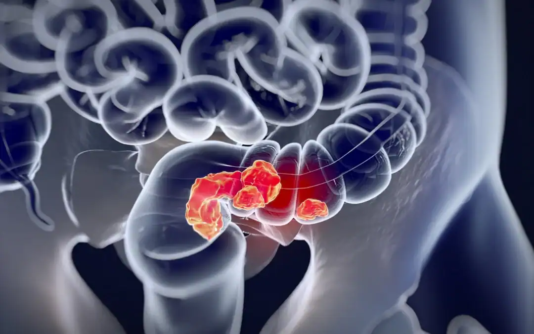 Ganglions et cancer colorectal : pourquoi ça compte
